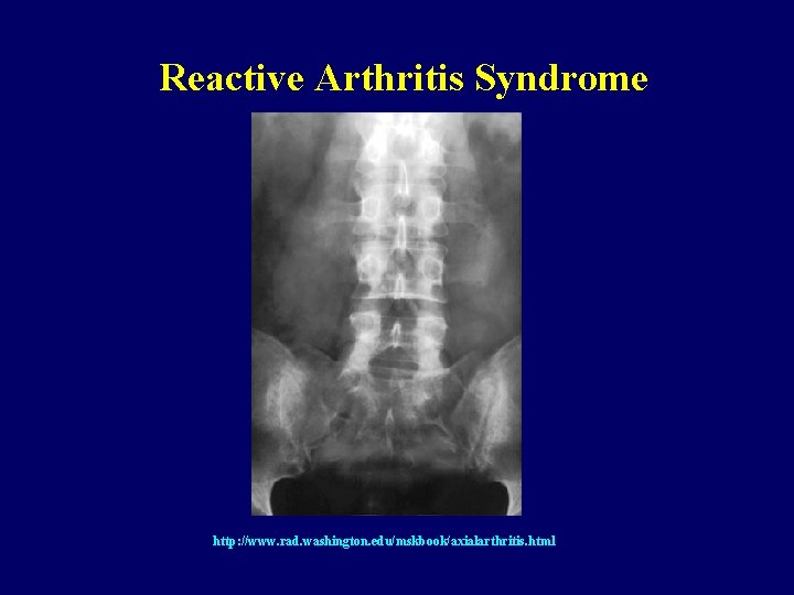 Reactive Arthritis Syndrome http: //www. rad. washington. edu/mskbook/axialarthritis. html 