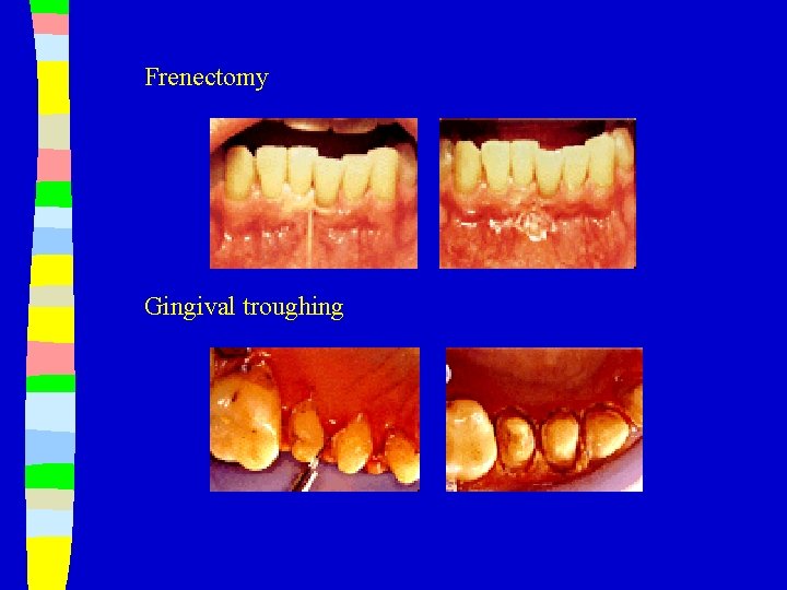 Frenectomy Gingival troughing 