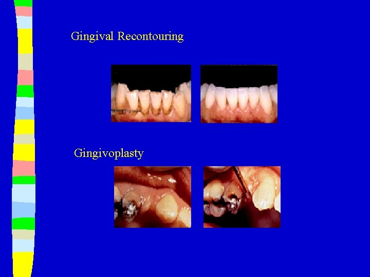 Gingival Recontouring Gingivoplasty 