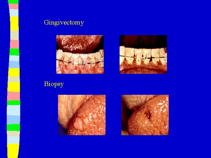 Gingivectomy Biopsy 