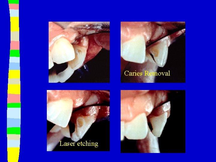 Caries Removal Laser etching 