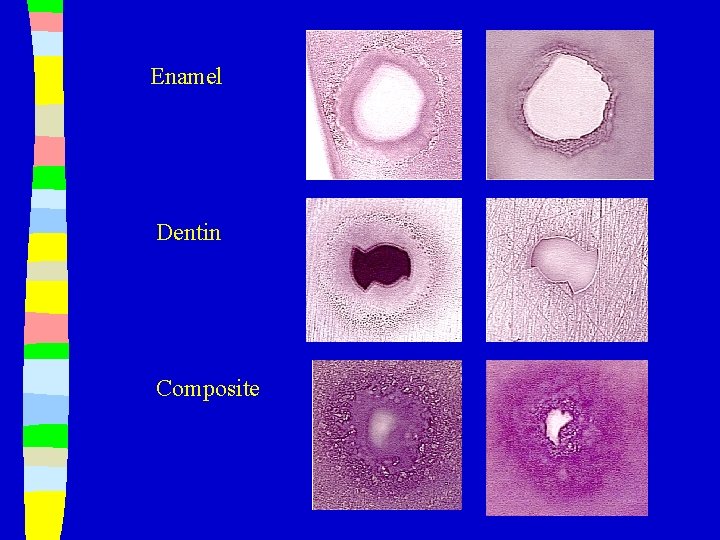 Enamel Dentin Composite 