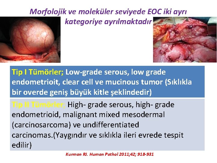 Morfolojik ve moleküler seviyede EOC iki ayrı kategoriye ayrılmaktadır Tip I Tümörler; Low-grade serous,