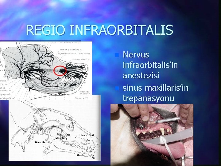 REGIO INFRAORBITALIS n n Nervus infraorbitalis’in anestezisi sinus maxillaris’in trepanasyonu 