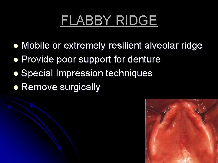 FLABBY RIDGE Mobile or extremely resilient alveolar ridge l Provide poor support for denture