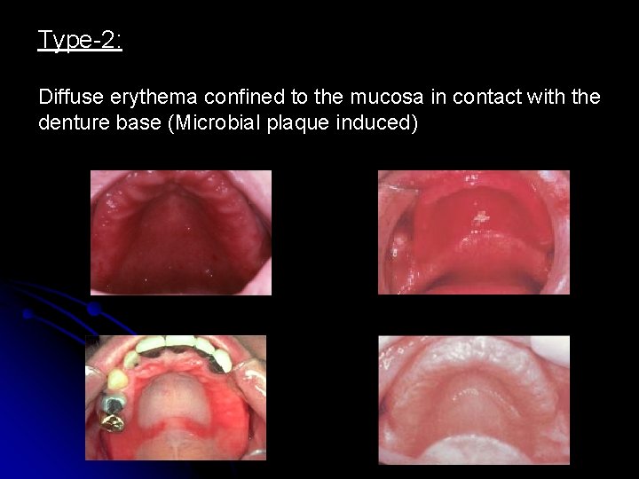 Type-2: Diffuse erythema confined to the mucosa in contact with the denture base (Microbial