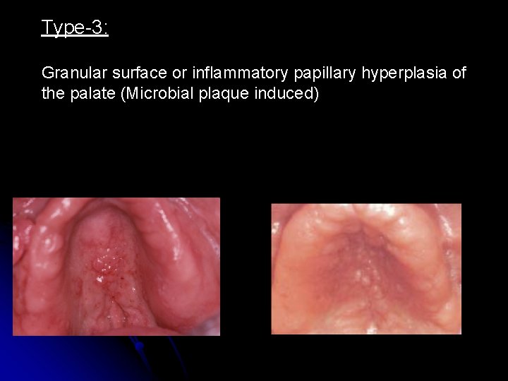 Type-3: Granular surface or inflammatory papillary hyperplasia of the palate (Microbial plaque induced) 