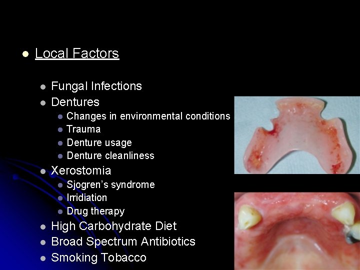 l Local Factors l l Fungal Infections Dentures l l l Xerostomia l l