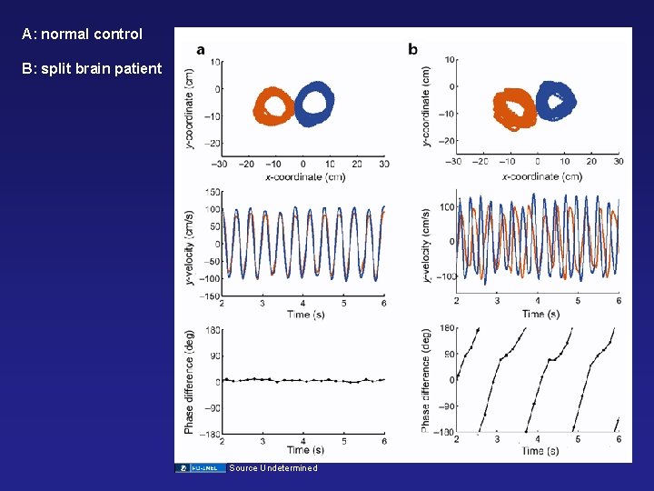 A: normal control B: split brain patient Source Undetermined 