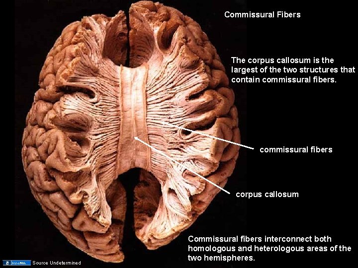 Commissural Fibers The corpus callosum is the largest of the two structures that contain