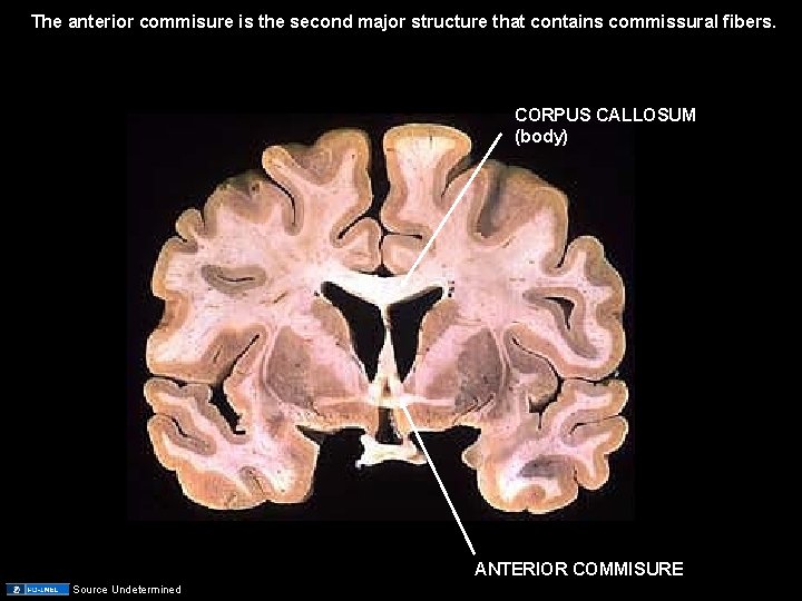 The anterior commisure is the second major structure that contains commissural fibers. CORPUS CALLOSUM