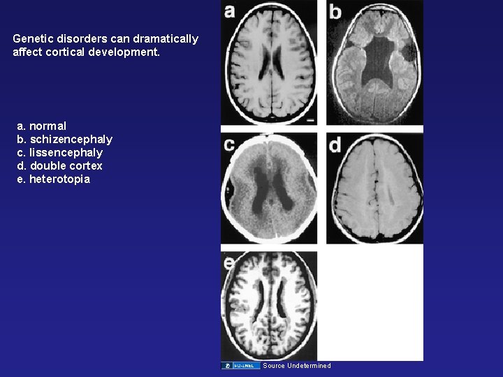 Genetic disorders can dramatically affect cortical development. a. normal b. schizencephaly c. lissencephaly d.