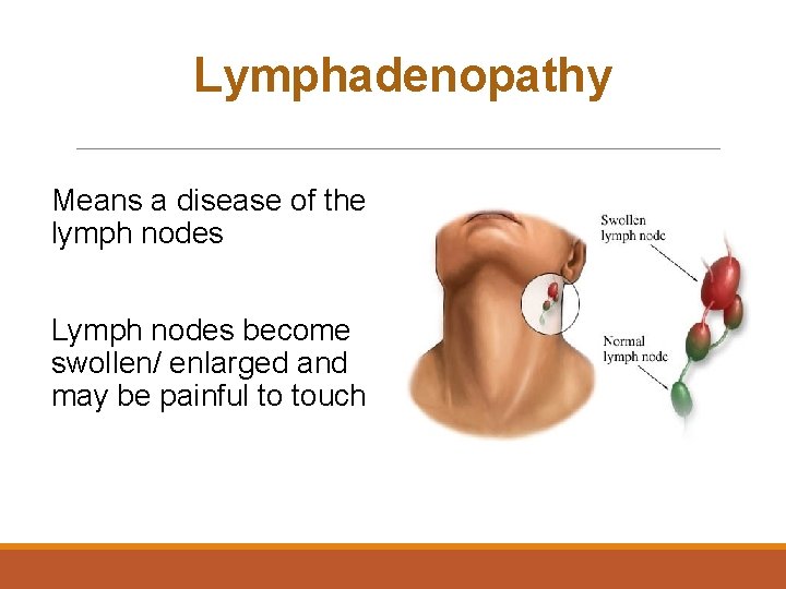 Lymphadenopathy Means a disease of the lymph nodes Lymph nodes become swollen/ enlarged and