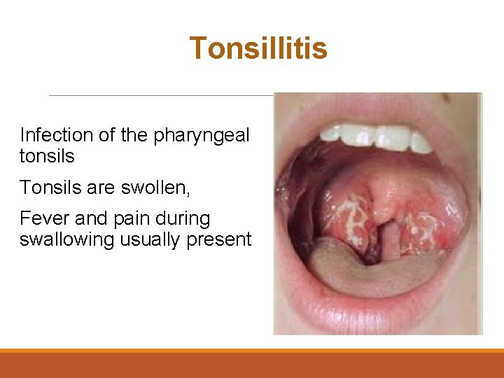 Tonsillitis Infection of the pharyngeal tonsils Tonsils are swollen, Fever and pain during swallowing