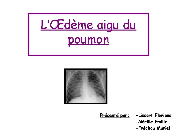 L’Œdème aigu du poumon Présenté par: -Lissart Floriane -Mérille Emilie -Fréchou Muriel L’Œdème aigu du poumon Présenté par: -Lissart Floriane -Mérille Emilie -Fréchou Muriel