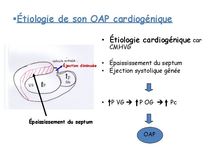 §Étiologie de son OAP cardiogénique • Étiologie cardiogénique car CMHVG Éjection diminuée • Épaississement §Étiologie de son OAP cardiogénique • Étiologie cardiogénique car CMHVG Éjection diminuée • Épaississement