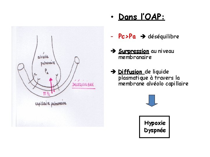 • Dans l’OAP: - Pc>Pa déséquilibre Surpression au niveau membranaire Diffusion de liquide • Dans l’OAP: - Pc>Pa déséquilibre Surpression au niveau membranaire Diffusion de liquide