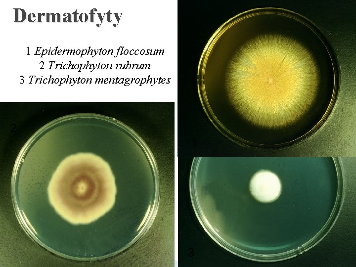 Dermatofyty 1 Epidermophyton floccosum 2. Trichophyton rubrum 3. Trichophyton mentagrophytes 2 1 3 