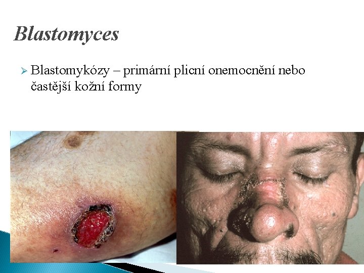 Blastomyces Ø Blastomykózy – primární plicní onemocnění nebo častější kožní formy 