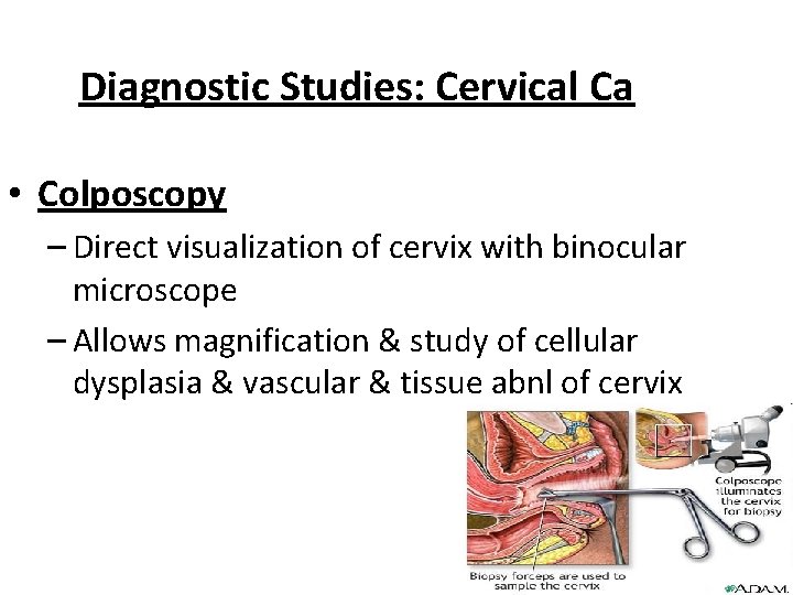 Diagnostic Studies: Cervical Ca • Colposcopy – Direct visualization of cervix with binocular microscope