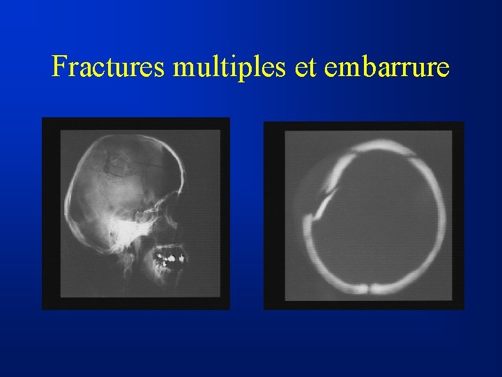 Fractures multiples et embarrure 