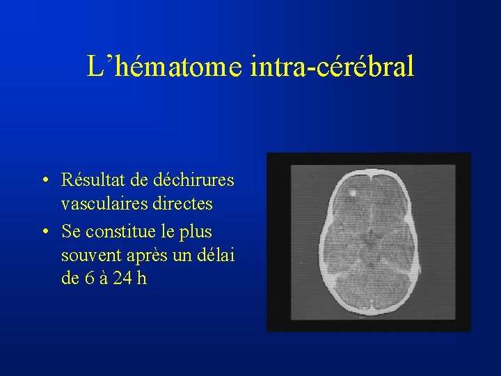 L’hématome intra-cérébral • Résultat de déchirures vasculaires directes • Se constitue le plus souvent