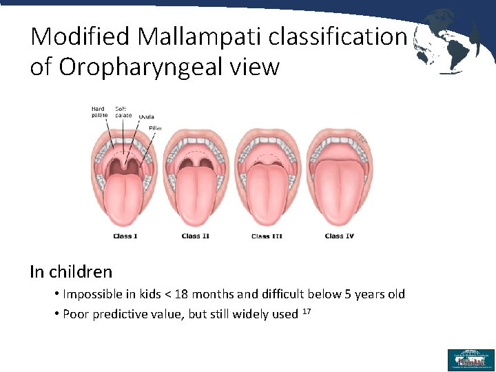 Modified Mallampati classification of Oropharyngeal view In children • Impossible in kids < 18