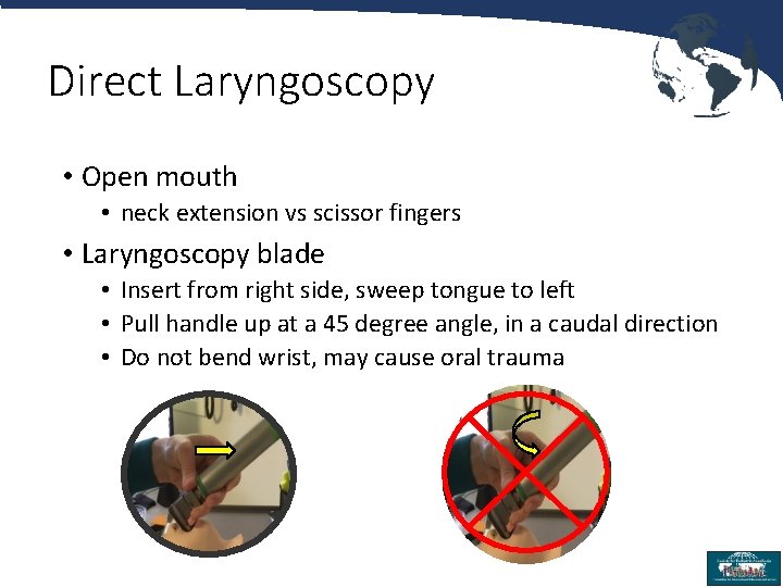 Direct Laryngoscopy • Open mouth • neck extension vs scissor fingers • Laryngoscopy blade