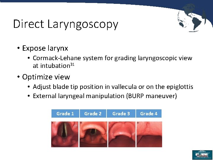 Direct Laryngoscopy • Expose larynx • Cormack-Lehane system for grading laryngoscopic view at intubation