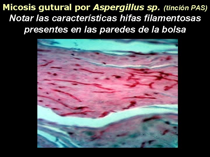 Micosis gutural por Aspergillus sp. (tinción PAS) Notar las características hifas filamentosas presentes en