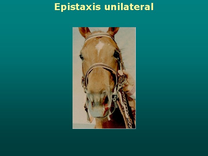 Epistaxis unilateral 