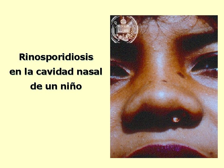 Rinosporidiosis en la cavidad nasal de un niño 
