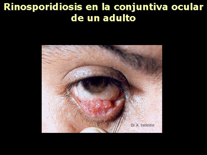 Rinosporidiosis en la conjuntiva ocular de un adulto 