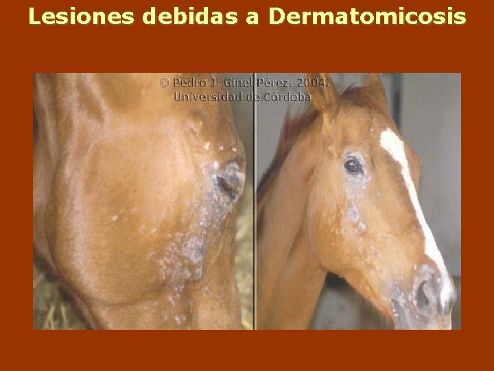 Lesiones debidas a Dermatomicosis 