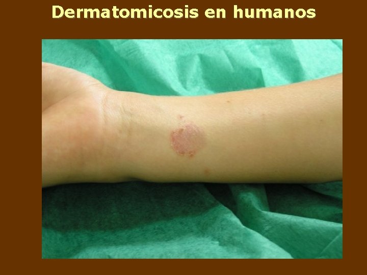 Dermatomicosis en humanos 