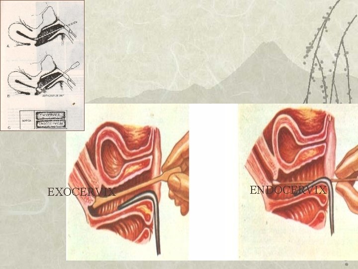 EXOCERVIX ENDOCERVIX EXOCERVIX ENDOCERVIX