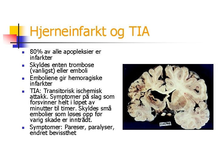 Hjerneinfarkt og TIA n n n 80% av alle apopleksier er infarkter Skyldes enten