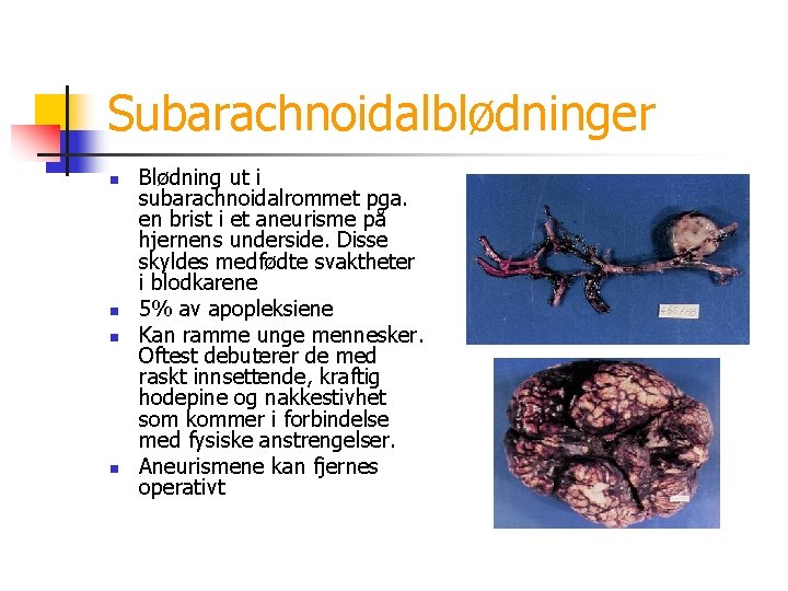 Subarachnoidalblødninger n n Blødning ut i subarachnoidalrommet pga. en brist i et aneurisme på