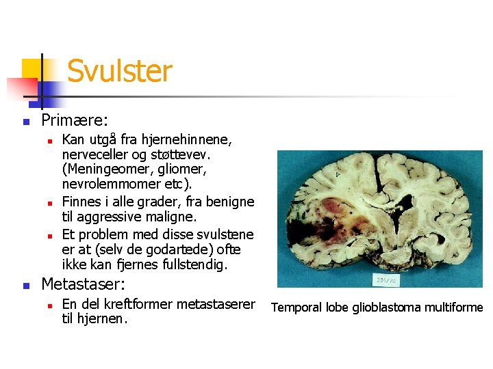 Svulster n Primære: n n Kan utgå fra hjernehinnene, nerveceller og støttevev. (Meningeomer, gliomer,