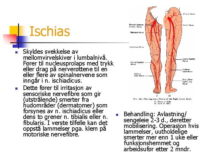 Ischias n n Skyldes svekkelse av mellomvirvelskiver i lumbalnivå. Fører til nucleusprolaps med trykk