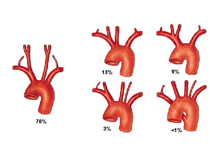 13% 9% 3% <1% 70% 