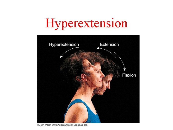 Hyperextension Hyperextension