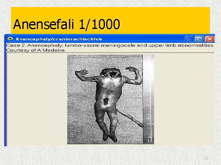 Anensefali 1/1000 18 