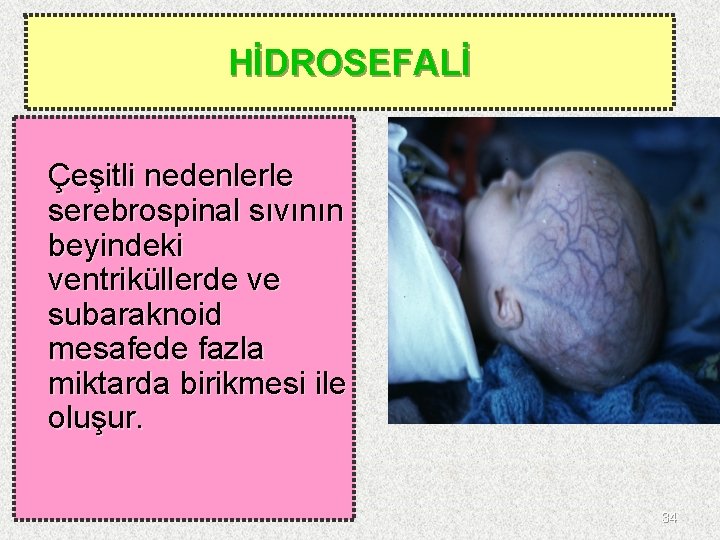 HİDROSEFALİ Çeşitli nedenlerle serebrospinal sıvının beyindeki ventriküllerde ve subaraknoid mesafede fazla miktarda birikmesi ile