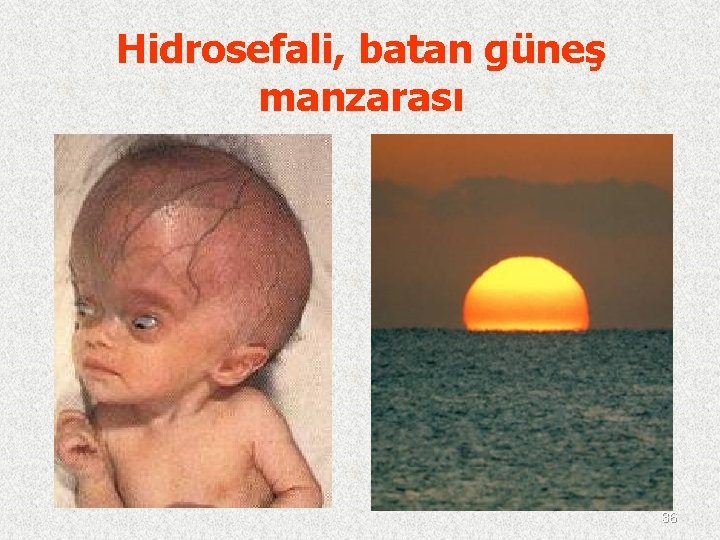 Hidrosefali, batan güneş manzarası 36 