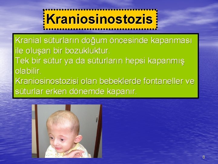 Kraniosinostozis Kranial süturların doğum öncesinde kapanması ile oluşan bir bozukluktur. Tek bir sütur ya