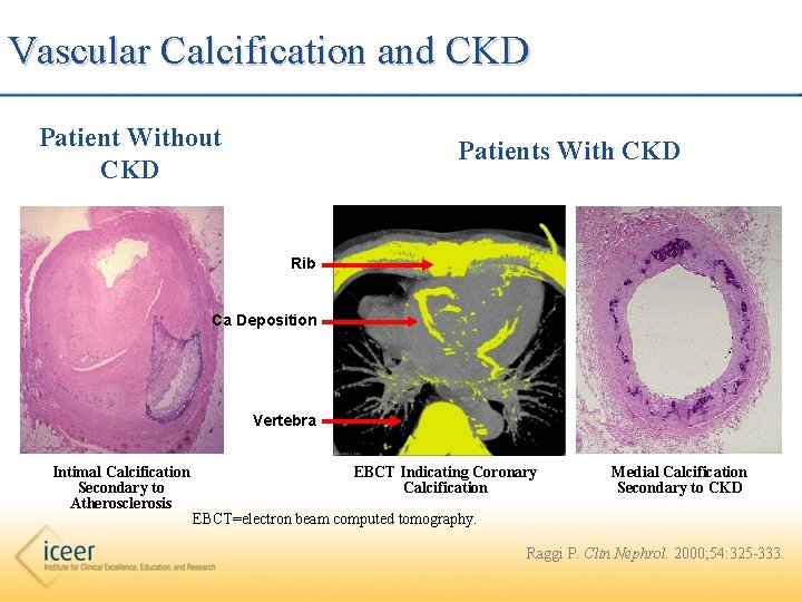 Vascular Calcification and CKD Patient Without CKD Patients With CKD Rib Ca Deposition Vertebra