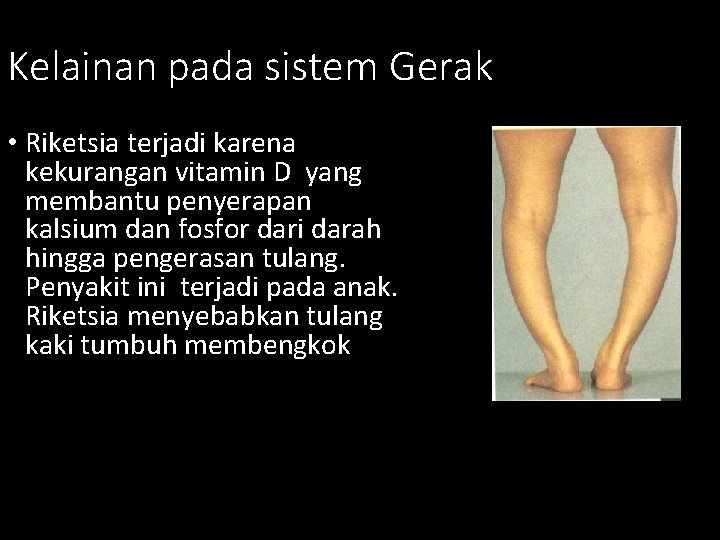 Kelainan pada sistem Gerak • Riketsia terjadi karena kekurangan vitamin D yang membantu penyerapan