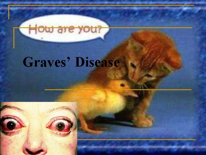 : Graves’ Disease 