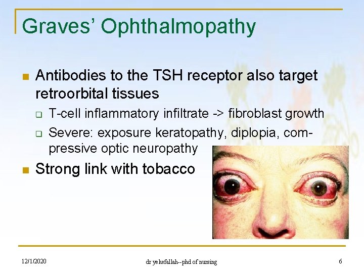 Graves’ Ophthalmopathy n Antibodies to the TSH receptor also target retroorbital tissues q q